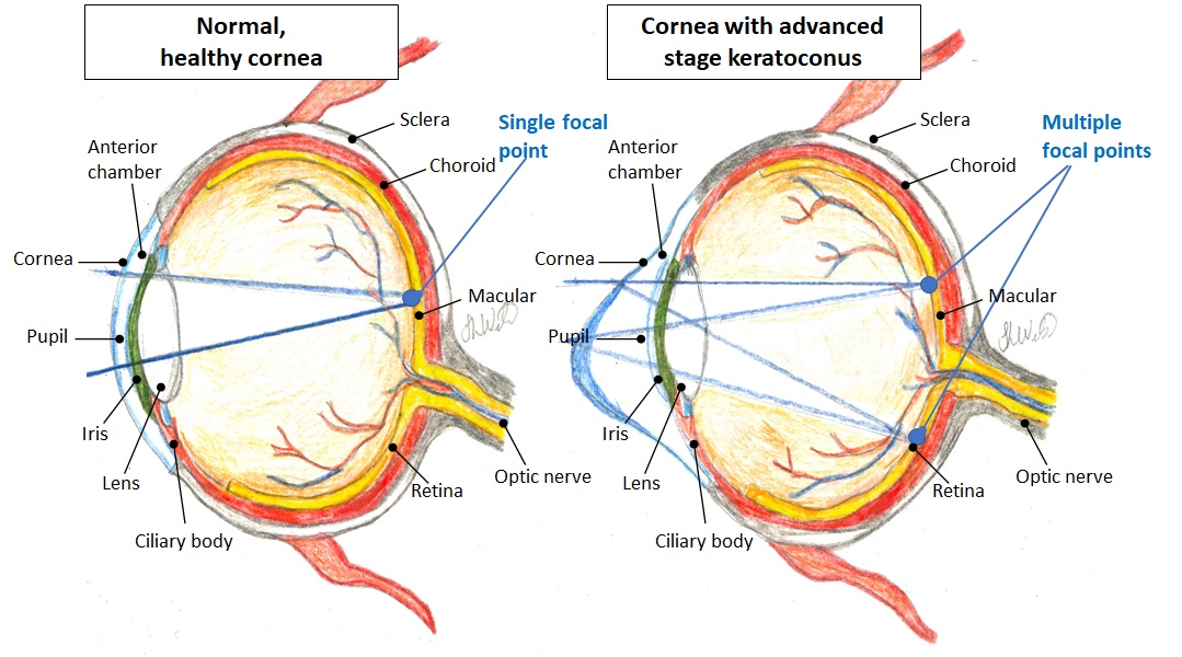 Fight for Sight – Small Grant Award